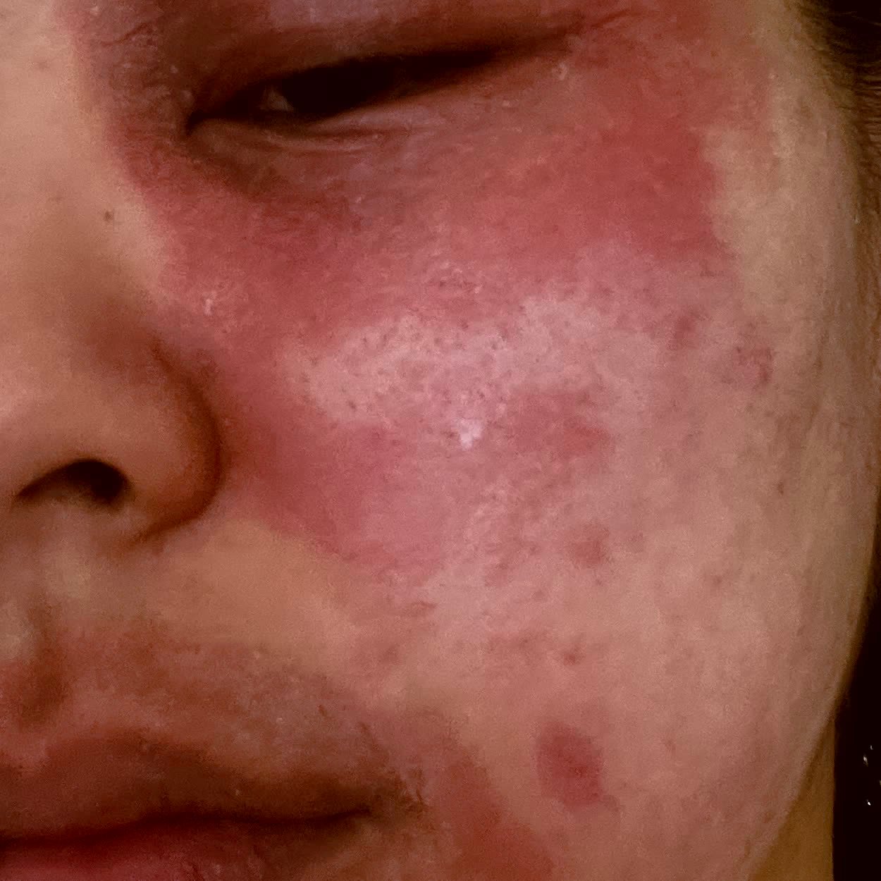 Founder's skin, before using P.Organics